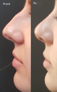 korekcja nosa Medfemina