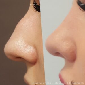 korekcja nosa